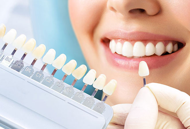 オフィスホワイトニング